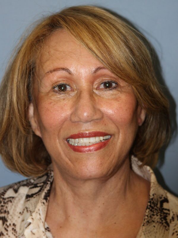 After — Brow Lift