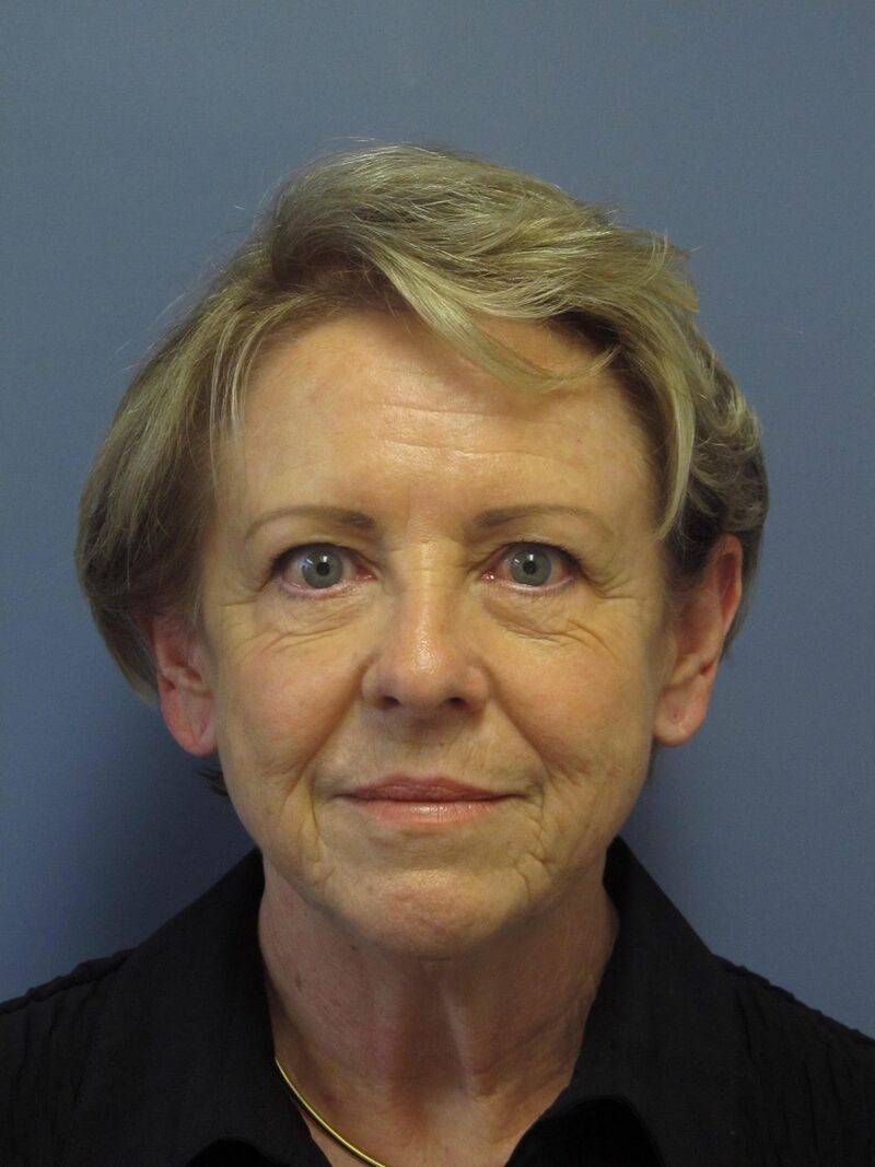 Before — Brow Lift