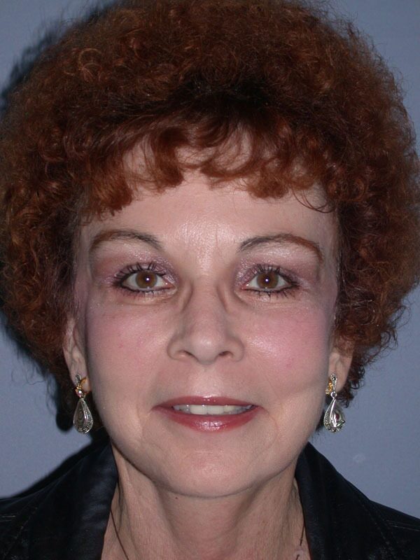 After — Brow Lift