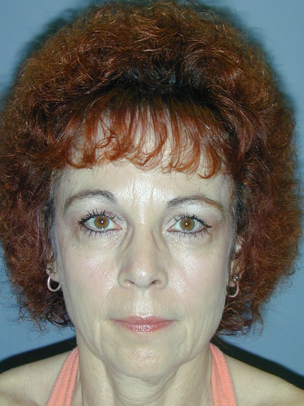 Before — Brow Lift