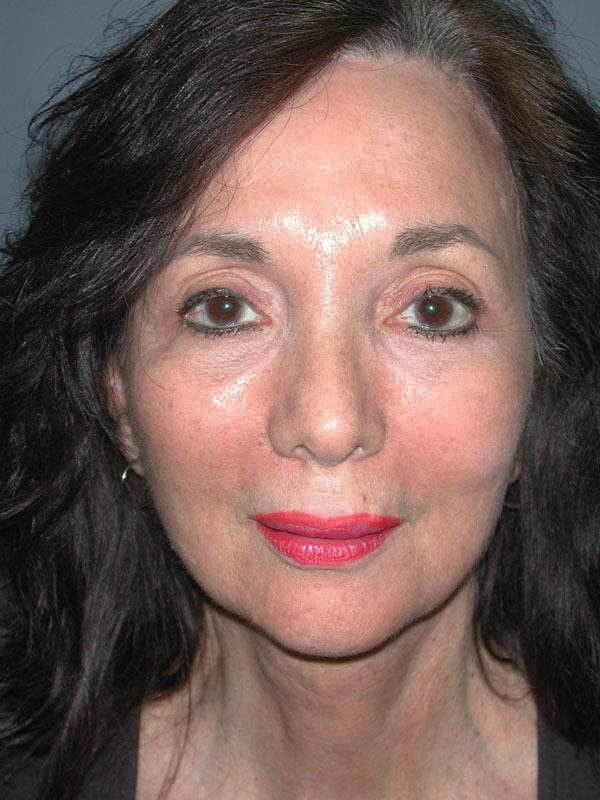 After — Face Lift