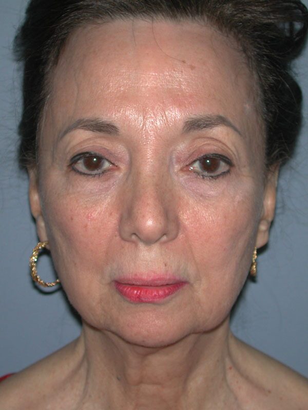 Before — Face Lift