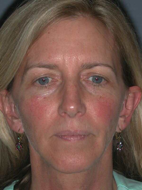 Before — Face Lift