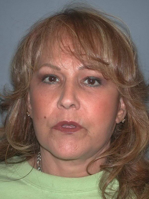 After — Face Lift