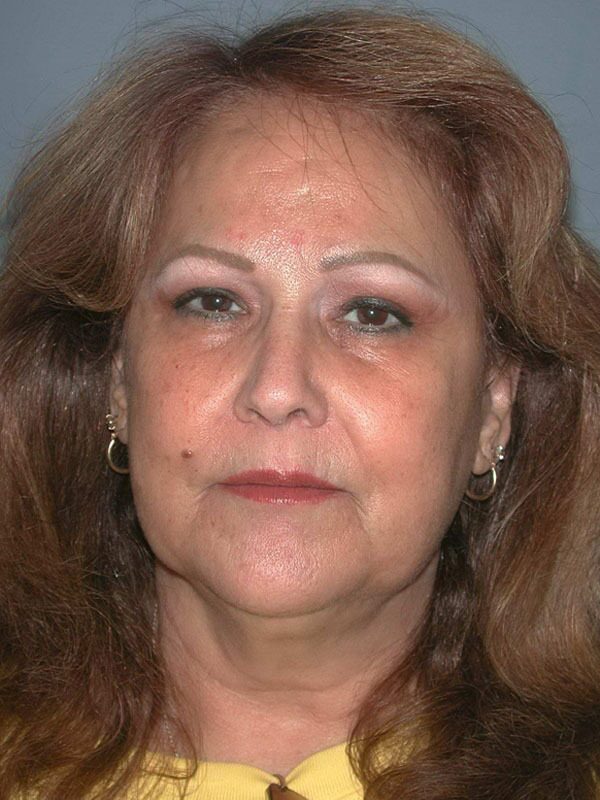 Before — Face Lift