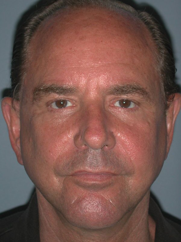 After — Face Lift
