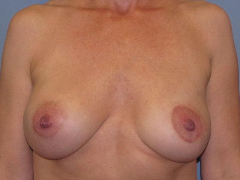 After — Breast Implant Revision on 57-year-old