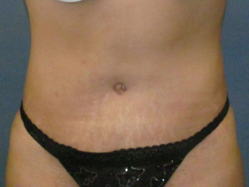 After — Liposuction
