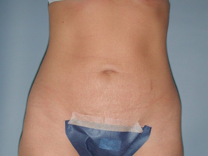 After — Liposuction