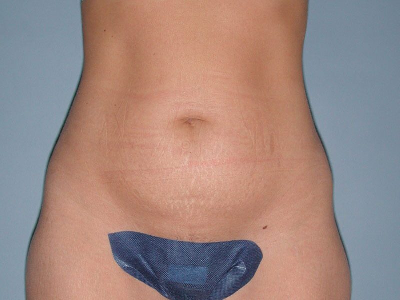 Before — Liposuction