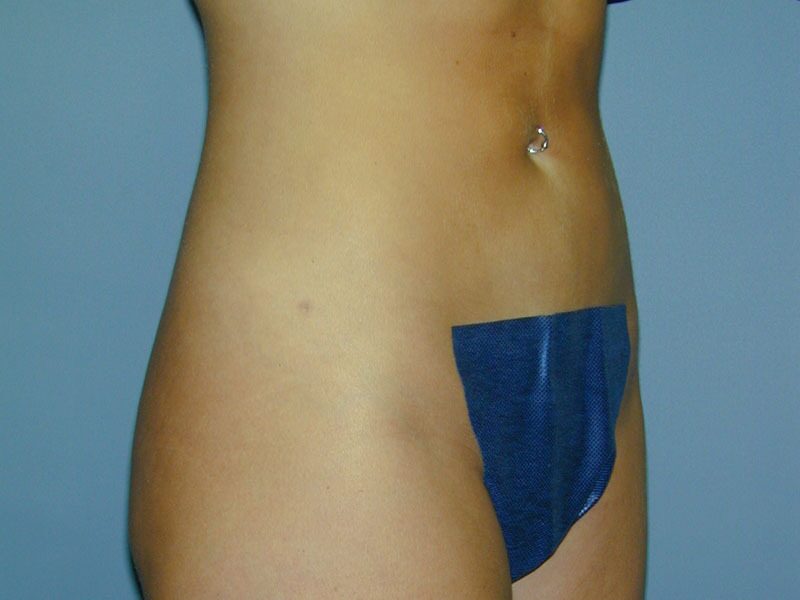 After — Liposuction