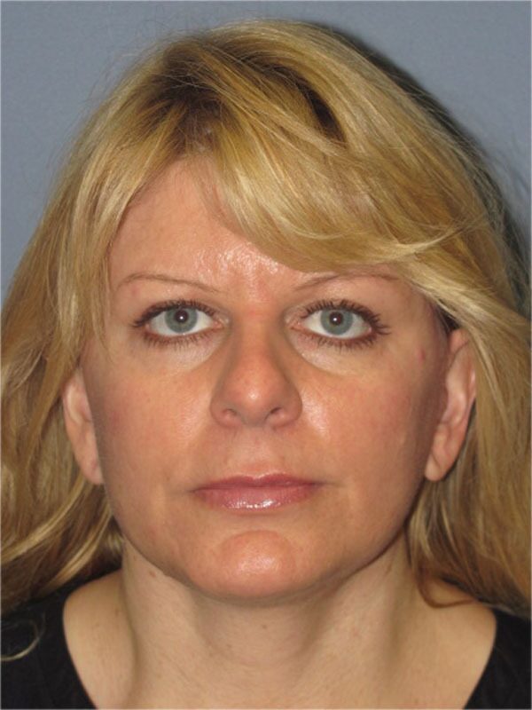 After — Lite Lift