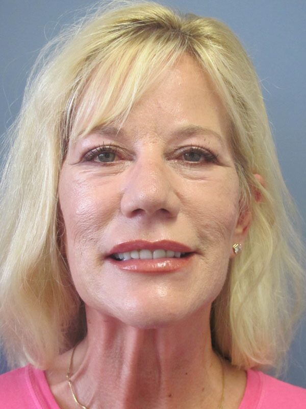 Before — Lite Lift