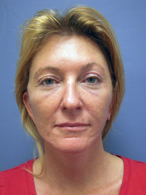 Before — Lite Lift