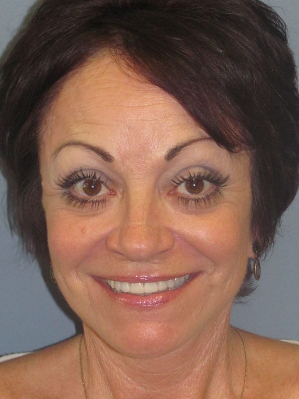 After — Lite Lift