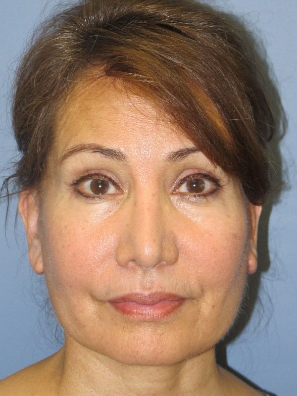 After — Lite Lift