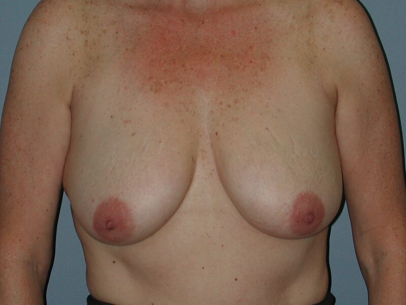 Before — Breast Lift