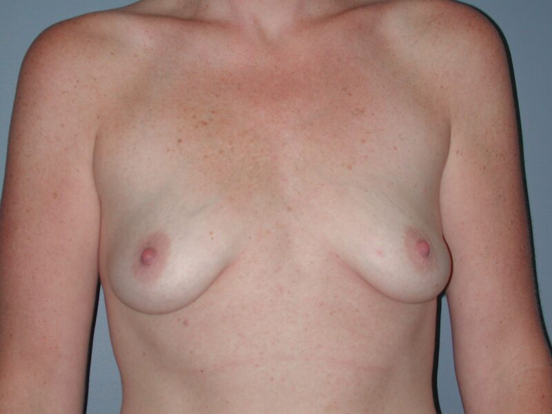 Before — Breast Lift