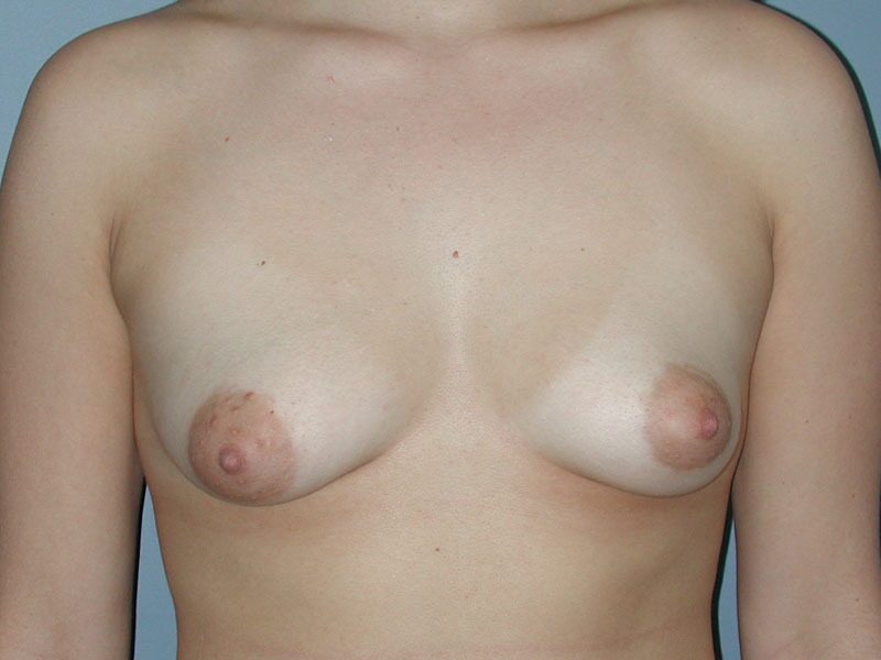 Before — Breast Lift