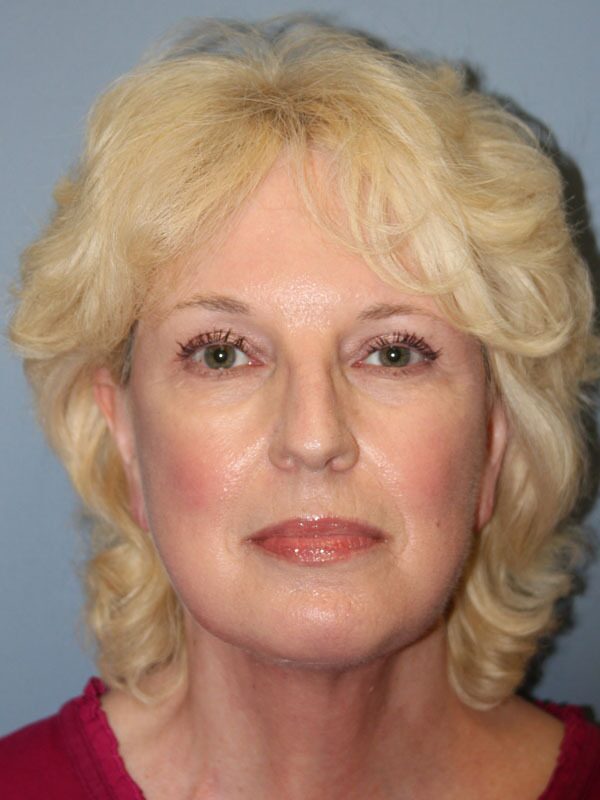 After — Neck Lift on 60-year-old