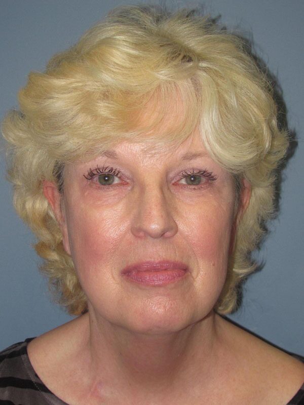Before — Neck Lift on 60-year-old