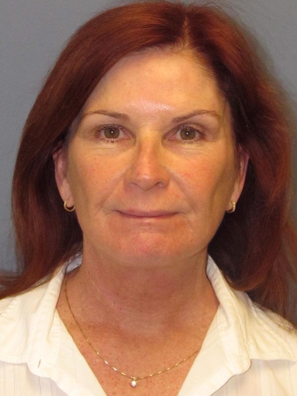 After — Neck Lift on 61-year-old