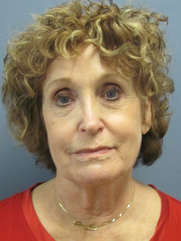 Before — Neck Lift