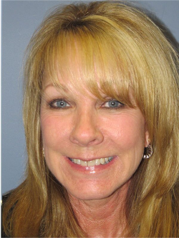 After — Neck Lift on 59-year-old