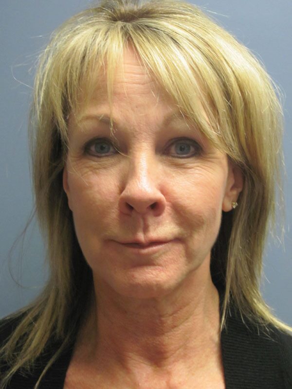 Before — Neck Lift on 59-year-old