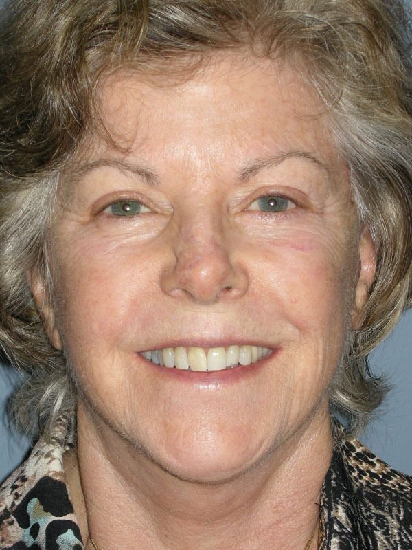 After — Neck Lift