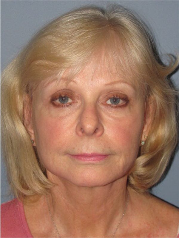 After — Neck Lift