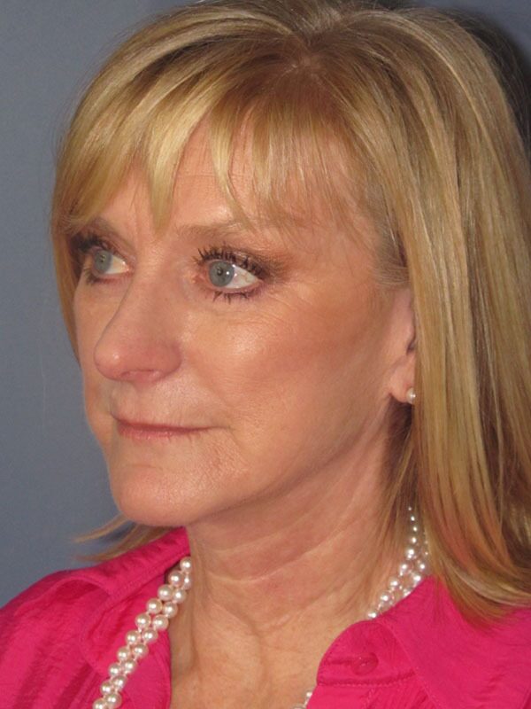 After — Neck Lift