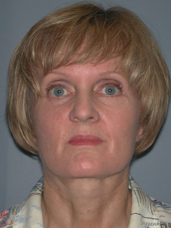 After — Neck Lift