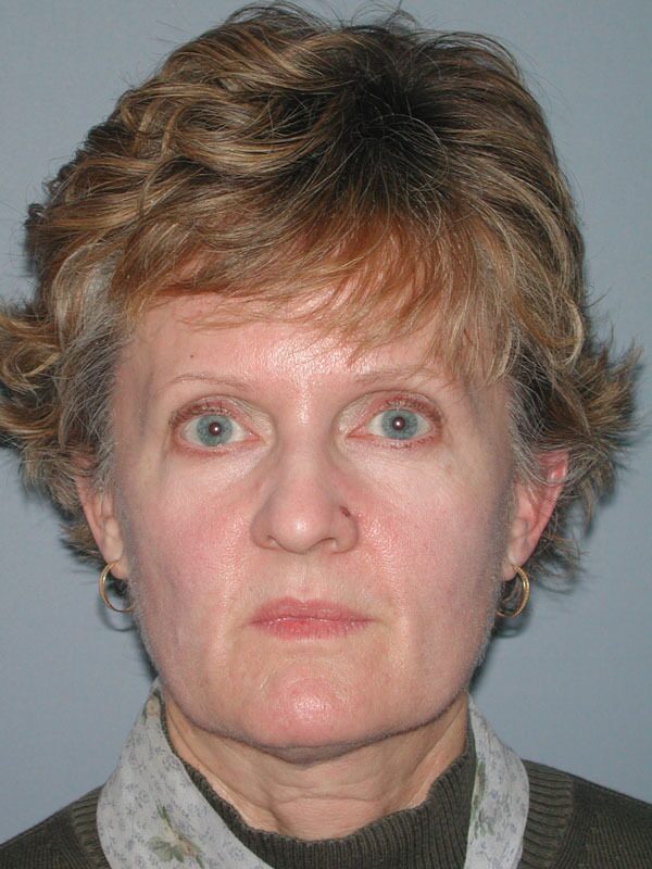 Before — Neck Lift