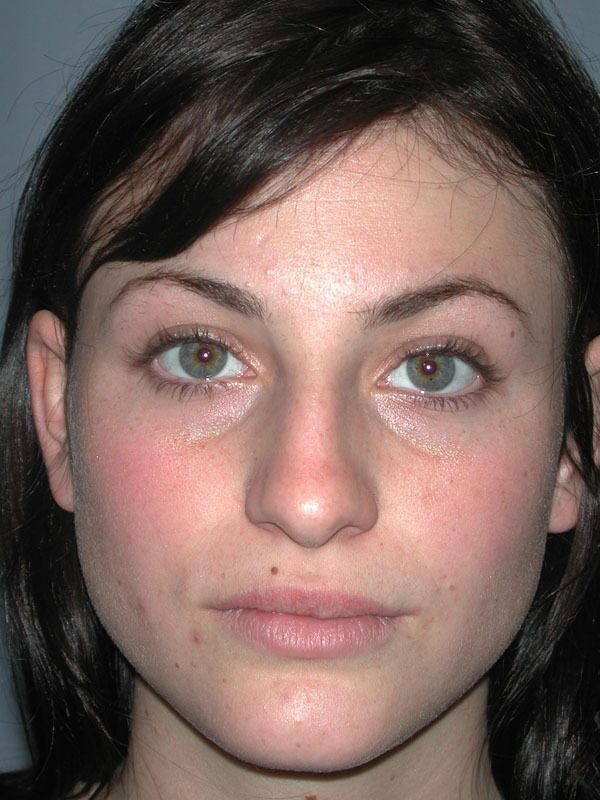 Before — Rhinoplasty